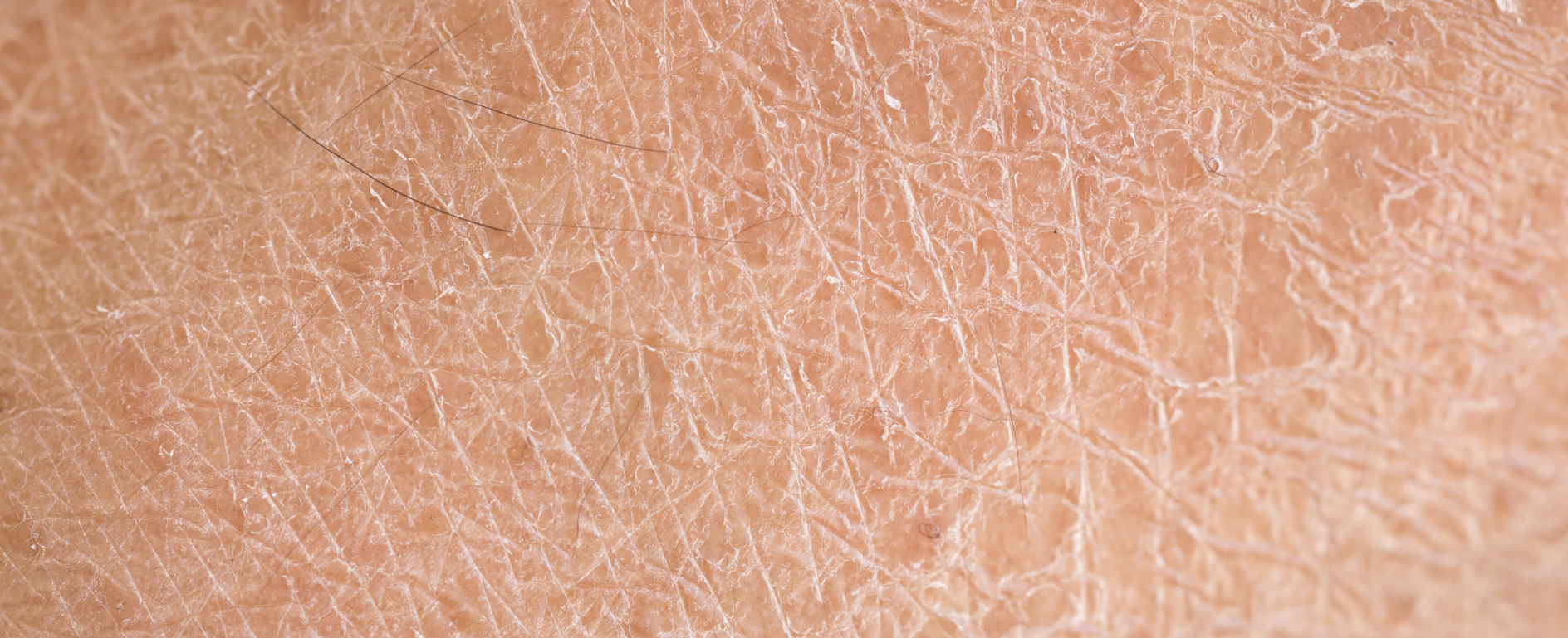 Dry Skin