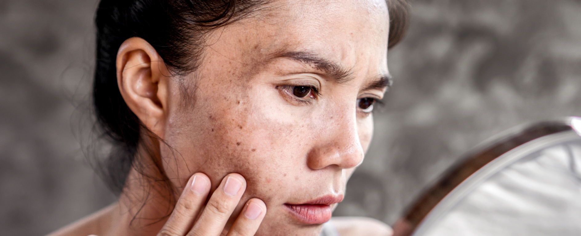Pigmentation